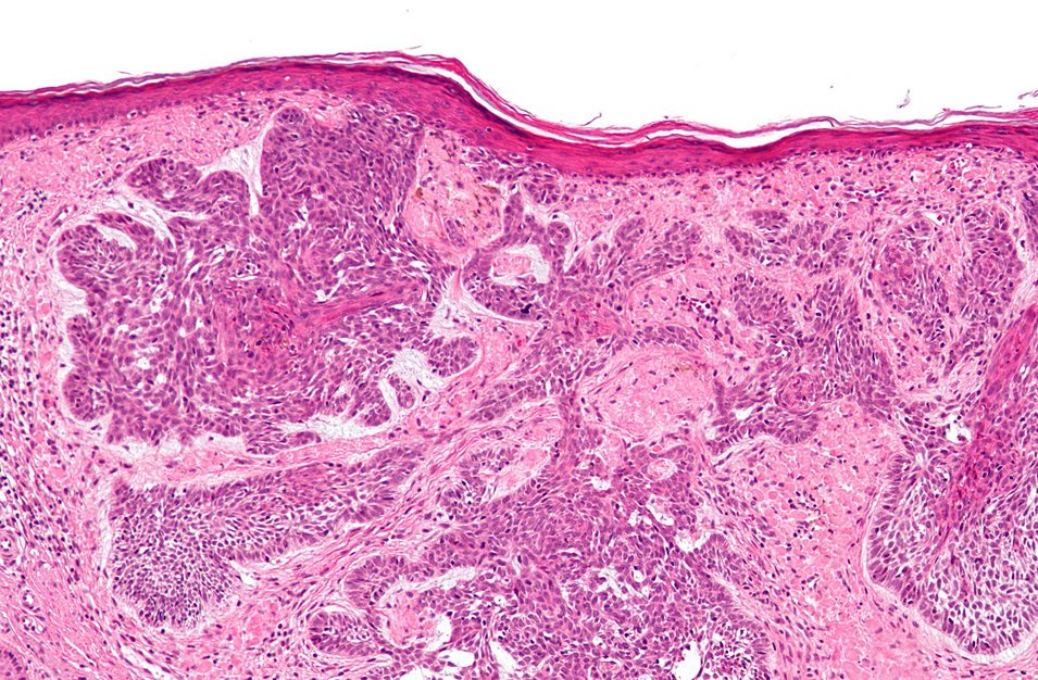 How to prevent the primary cause of skin cancer?