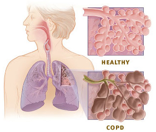 lung disease