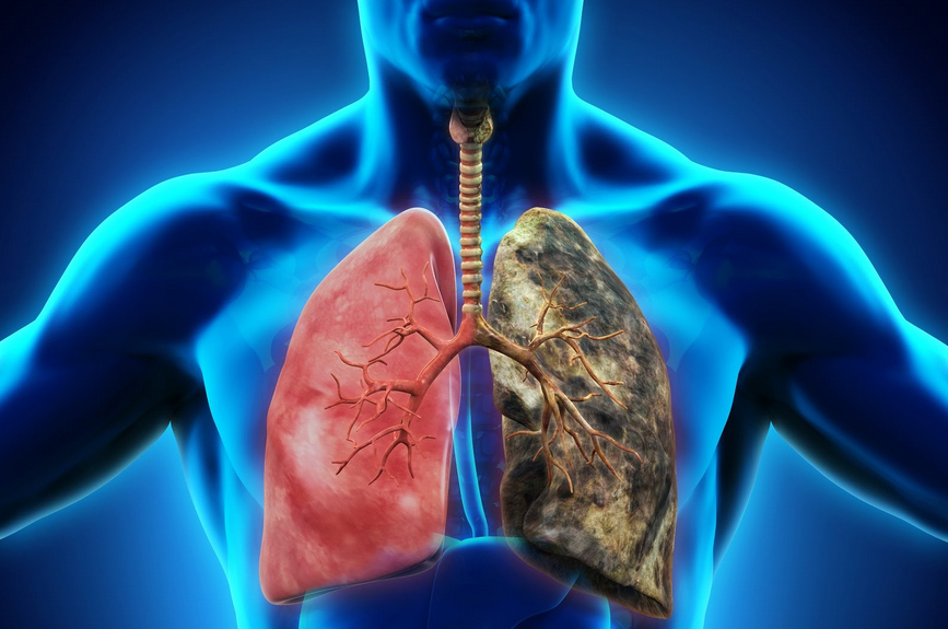 lungdisease