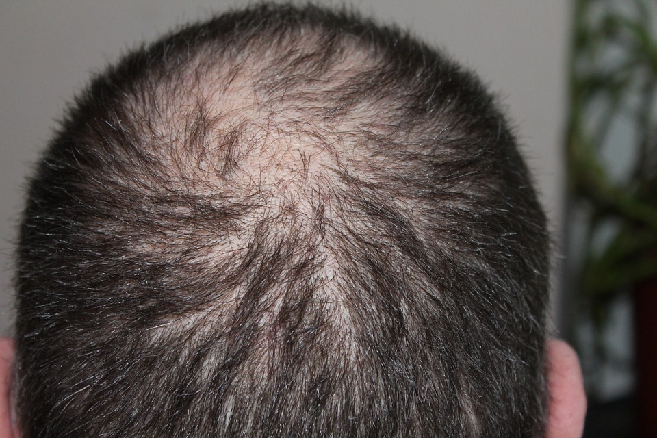 How to Prevent Hair Loss